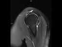 Sagittal T2 FS BLADE-MAGNETOM Altea