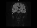 Coronal DIFF RESOLVE 800b-MAGNETOM Altea