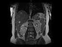 Coronal T2 HASTE low TE-MAGNETOM Sola