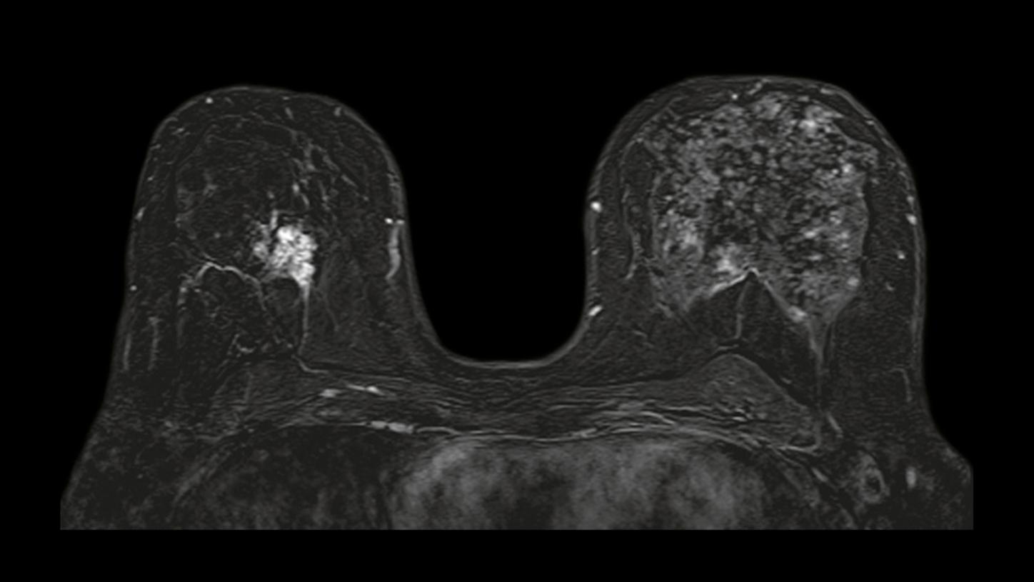 Breast MRI