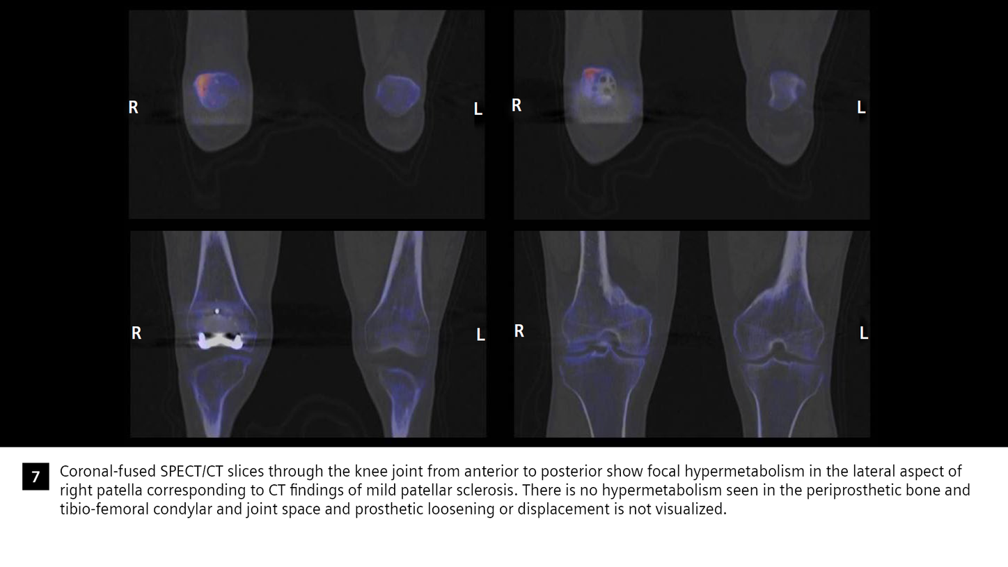 SPECT/CT in evaluation of anterior knee pain following patellofemoral ...