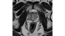 Prostate MRI