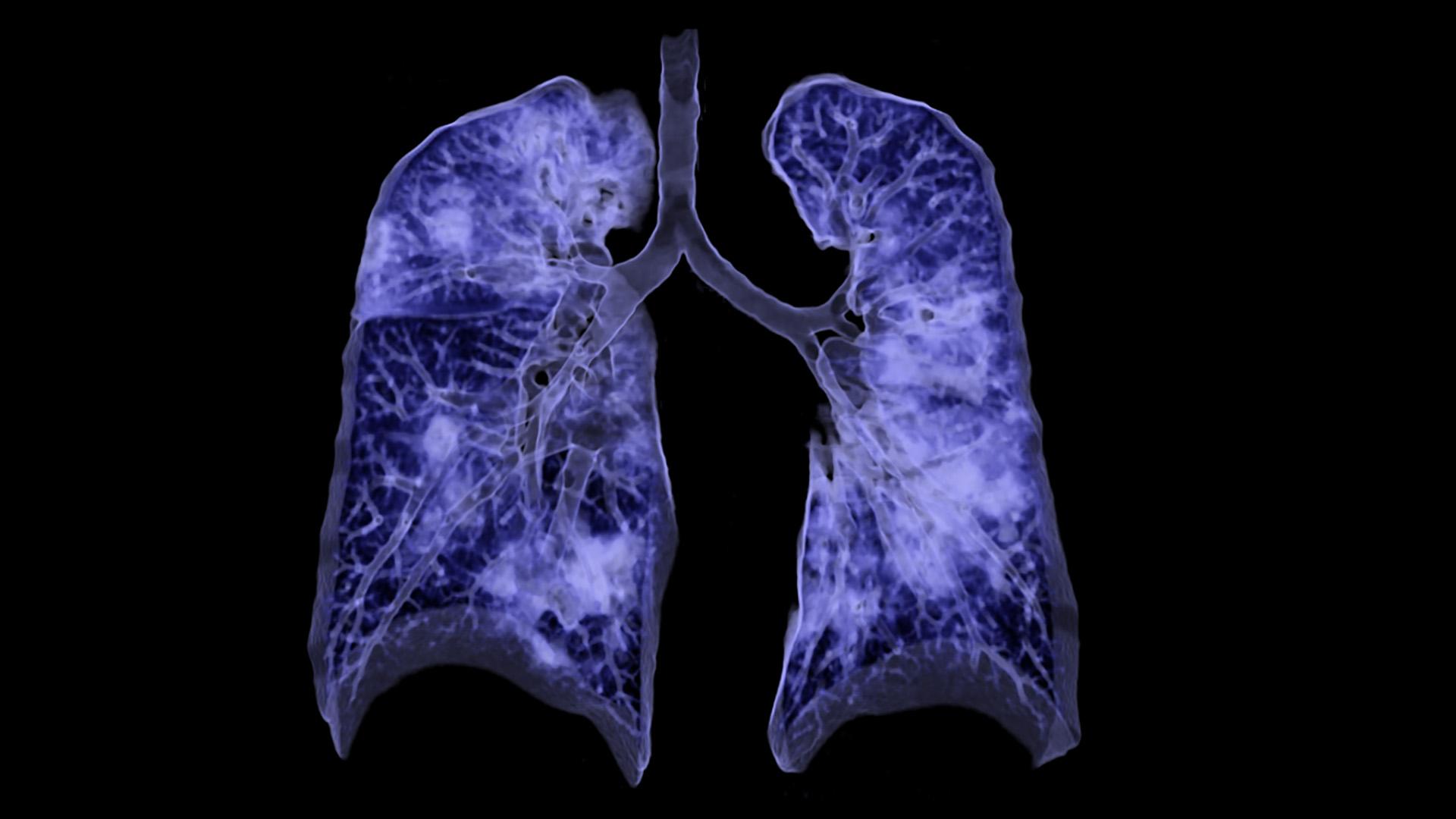 Pneumonia por COVID19 na Tomografia Computadorizada