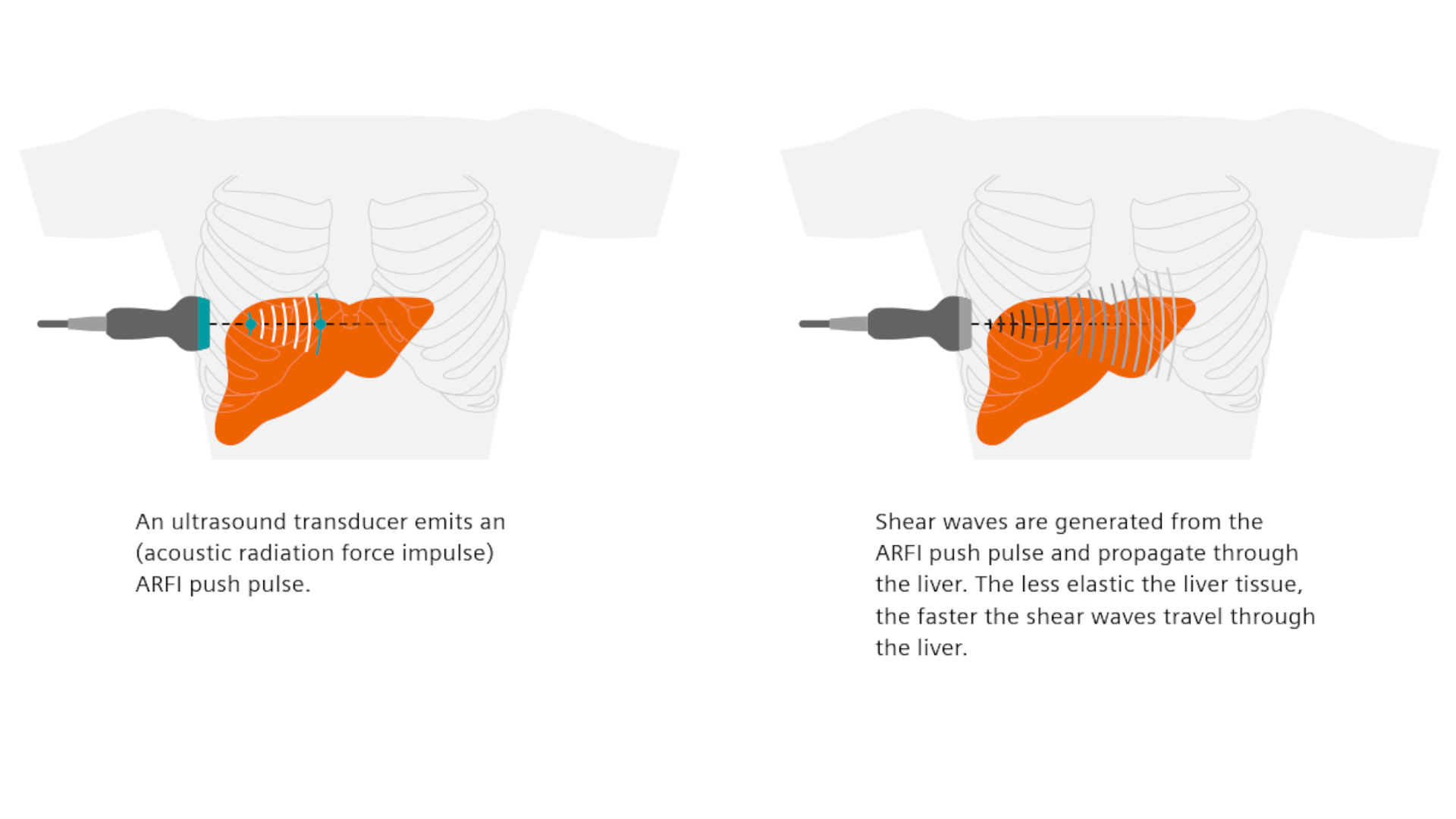 Liver fibrosis Patients can be at risk of death even without exhibiting symptoms