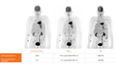Biograph Vision clinical case