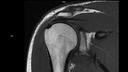 Coronal T1 DR Sharp-MAGNETOM Lumina/Coil-Shoulder Shape 16/Resolution-448/Scan Time-2:52