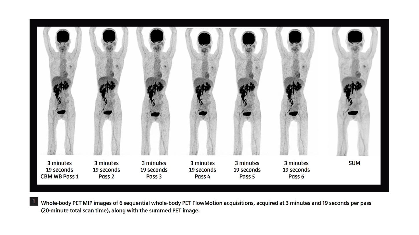 18f Fdg Pet Ct Delineation Of Diffuse Large B Cell Lymphoma Involving Lower Spinal Cord And Spinal Nerve Roots