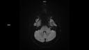 ep2D FS Diff AX b1000-MAGNETOM Sola/Coil-HeadNeck 20/Resolution-384/Scan Time-0:00/Aceleration-p2
