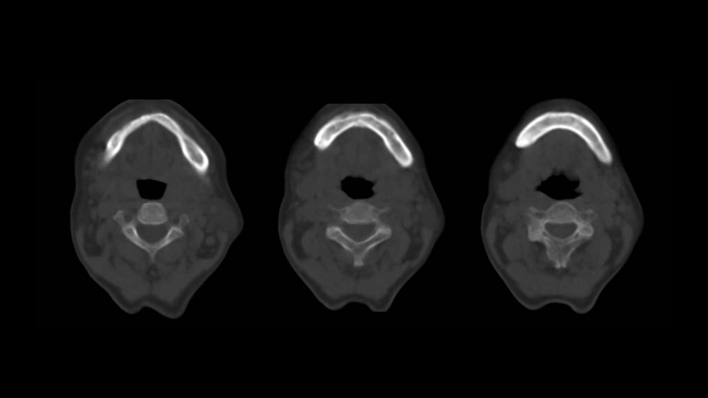 99mTc MDP SPECT/CT imaging in the evaluation of mandibular ...