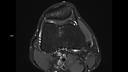 Axial PD FS DR Sharp-MAGNETOM Vida/Coil-Knee 18/Resolution-896/Scan Time-3:45