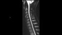 RESOLVE Diff SAG B600 w/coil shim-MAGNETOM Sola/Coil-HeadNeck 20/Resolution-164/Scan Time-5:37