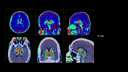 Biograph Vision clinical case