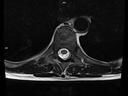 Axial T2 TSE-MAGNETOM Lumina/Coil-Spine 24/Resolution-320/Scan Time-3:50