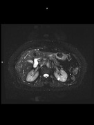 Axial T2 FS RT-MAGNETOM Free.Max/Coil-BM Contour Large/Spine/Resolution-544/Scan Time-0:47/Aceleration-p2