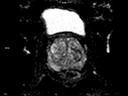 Axial Diffusion ADC-MAGNETOM Lumina/Coil-Body 12/Spine 24/Resolution-228/Scan Time-3:45