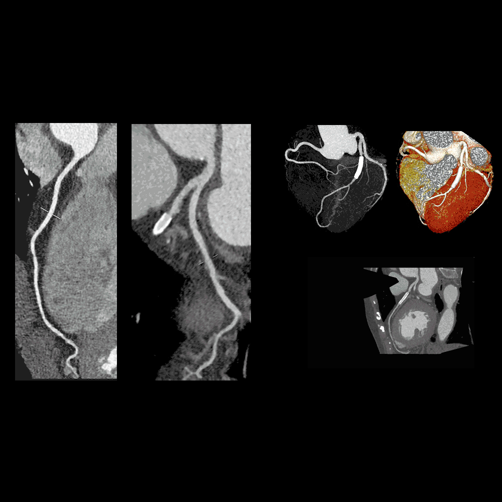 CT Cardiovascular imaging