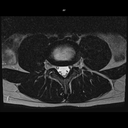 Axial T2-MAGNETOM Free.Max/Coil-Spine/Resolution-416/Scan Time-3:32/Aceleration-DRS