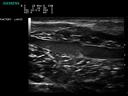 ACUSON P300 Ultrasound System - Vascular - Lower Leg Valve