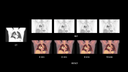 Biograph Vision clinical case