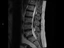 Sagittal T2-MAGNETOM Lumina/Coil-Spine 24/Resolution-384/Scan Time-1:45