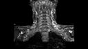 T2 SPACE STIR COR Thin MIP-MAGNETOM Sola/Coil-HeadNeck 20/Resolution-320/Scan Time-0:00/Aceleration-p3