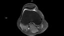Axial PD FS DR Sharp-MAGNETOM Sola/Coil-Knee 18/Resolution-768/Scan Time-2:48/Aceleration-p2