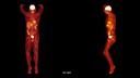 Biograph Vision clinical case