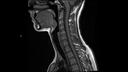 T1 TSE SAG-MAGNETOM Sola/Coil-HeadNeck 20/Resolution-320/Scan Time-3:22