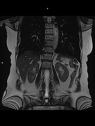 Coronal T2 BH-MAGNETOM Free.Max/Coil-BM Contour Large/Spine/Resolution-512/Scan Time-0:15/Aceleration-p2