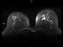 Axial RESOLVE Diffusion-MAGNETOM Lumina/Coil-Breast 18/Resolution-200/Scan Time-4:02/Aceleration-p2