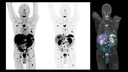Single-bed, whole-body 68Ga DOTATATE PET/CT delineation of neuroendocrine tumor metastases