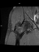 Coronal PD FS-MAGNETOM Free.Max/Coil-Contour Small/Resolution-416/Scan Time-3:41/Aceleration-DRS
