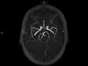 Axial 3D TOF MIP-MAGNETOM Altea/Coil-HeadNeck20/Resolution-504/Scan Time-2:00/Aceleration-cs7.5