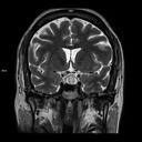 Coronal T2 TSE-MAGNETOM Vida/Coil-Head Neck 20/Resolution-512/Scan Time-2:48