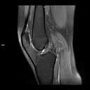 Sagittal PD FS-MAGNETOM Free.Max/Coil-Contour Small/Resolution-576/Scan Time-3:13/Aceleration-p2 s2 DRS
