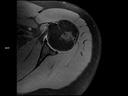 Coronal T1 TSE-MAGNETOM Lumina/Coil-Shoulder Shape 16/Resolution-368/Scan Time-3:00/Aceleration-p2