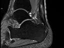 Sagittal PD tse fs