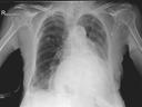 Mobilett Mira Max Chest VIII lying a.p. Image