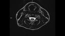 T2 SPACE AX-MAGNETOM Sola/Coil-HeadNeck 20/Resolution-256/Scan Time-3:29