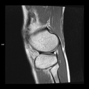 Sagittal PD-MAGNETOM Free.Max/Coil-Contour Small/Resolution-640/Scan Time-2:50/Aceleration-p2 s2 DRS