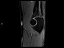 Sagittal PD FS-MAGNETOM Lumina<br />