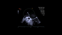 Septal Guide