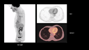 Biograph Vision clinical case