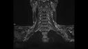 T2 SPACE STIR COR Fast-MAGNETOM Sola/Coil-HeadNeck 20/Resolution-320/Scan Time-3:39/Aceleration-p4