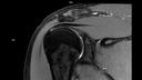 Coronal PD FS DR Sharp-MAGNETOM Lumina/Coil-Shoulder Shape 16/Resolution-768/Scan Time-5:04