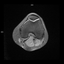 Axial PD FS-MAGNETOM Free.Max/Coil-Contour Small/Resolution-576/Scan Time-2:47/Aceleration-p2 s2 DRS