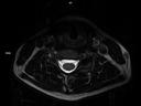 Axial T2 SPACE-MAGNETOM Lumina/Coil-HeadNeck 20/Spine 24/Resolution-640/Scan Time-3:58