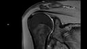 Coronal PD FS DR Sharp-MAGNETOM Lumina/Coil-UltraFlex 18 Small/Resolution-768/Scan Time-4:04