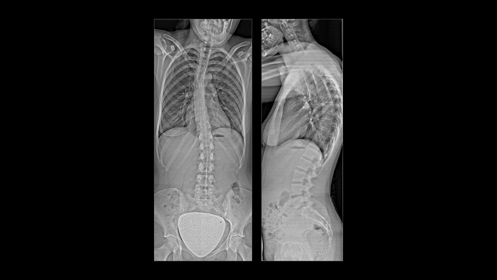 Twin Robotic X-ray scanner – Multitom Rax