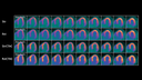 Biograph Vision clinical case